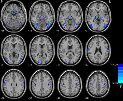 Decreased Resting-State Interhemispheric Functional Connectivity in Medication-Free Obsessive-Compulsive Disorder